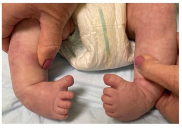 The babies had inwards facing feet that pointed downwards. 