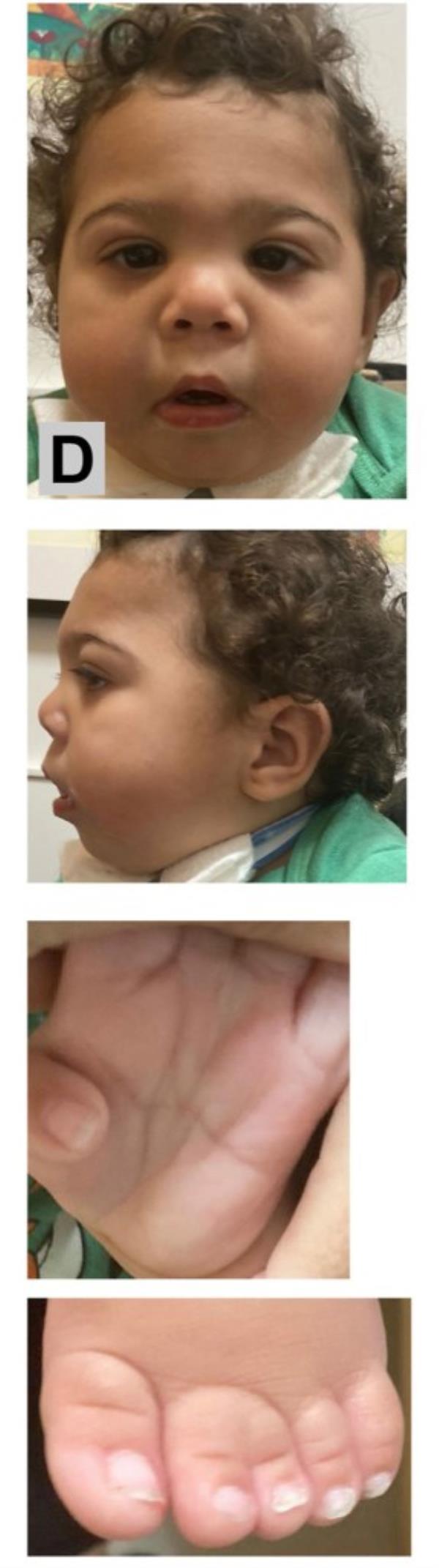The defects were similar to those seen in a genetic co<em></em>ndition called Smith-Lemli-Opitz, though no genetic cause was found. 