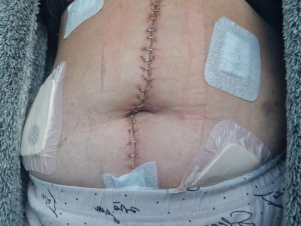 Charlotte's stomach with a line of staple from her chest to below her bully button