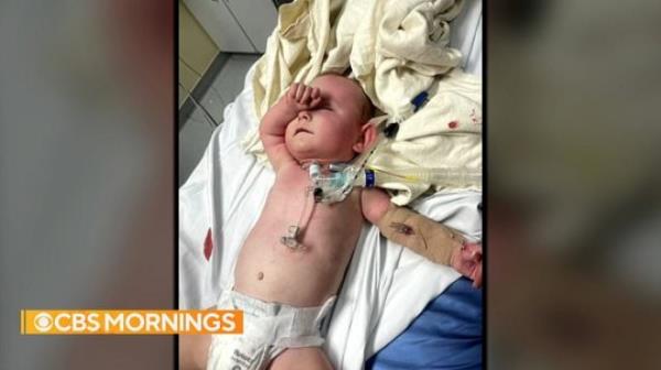The 17-month-old boy suffered burns, his mother said.